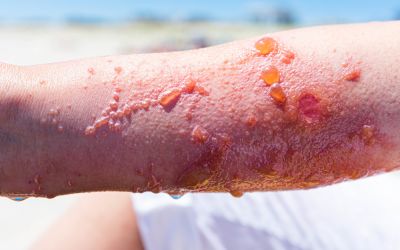 Poison Ivy Can Cause Serious Reactions