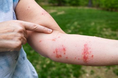 Some People are Allergic to Poison Ivy